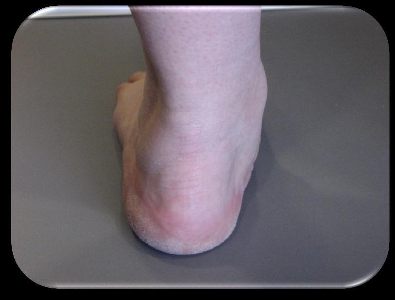 Valgus of the foot is where part of the foot or the whole foot is