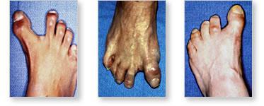 Varus is the term for a deformity of bone or bones of the leg or foot.