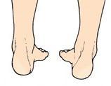 Supination is a tri-planar motion consisting of: Plantar Flexion in the