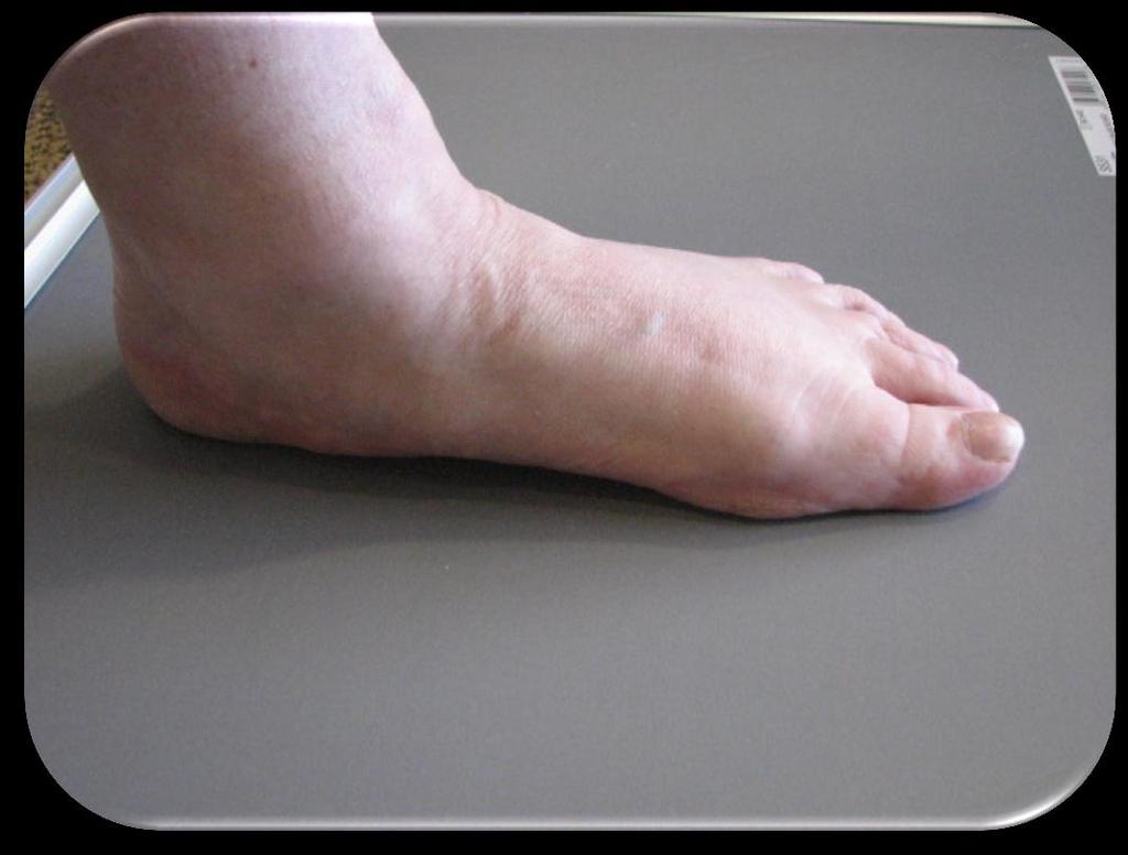 2. Pes Planus flatfoot; a condition in which