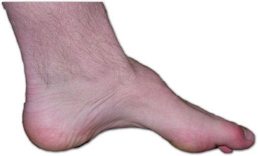 3. Pes Cavus a foot with a high arch which does not flatten with weight