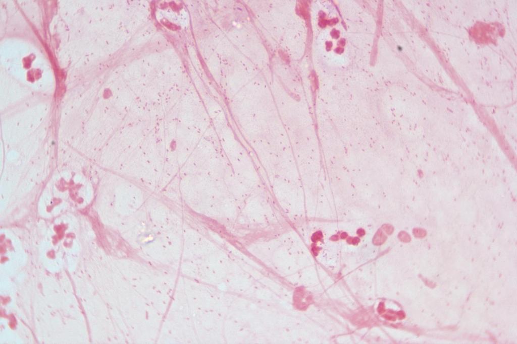 Gram negative coccobacilli suggestive of Haemophilus