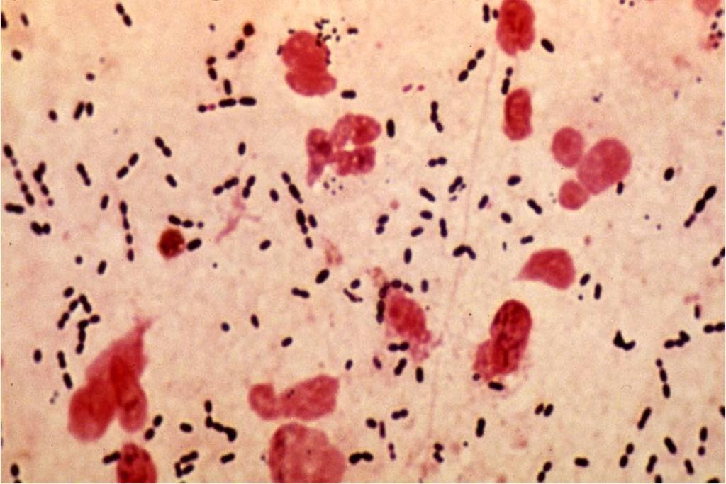 Gram positive cocci suggestive of Pneumococcus
