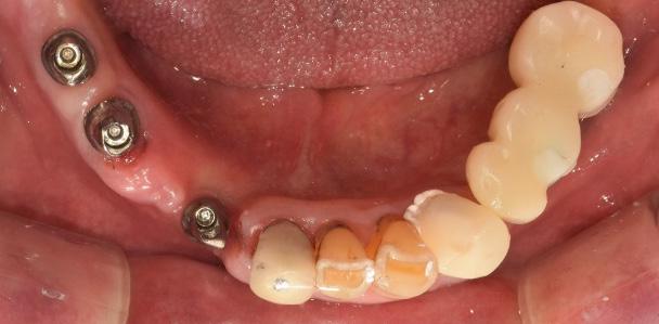 crowns for final prosthesis with the impression taken then.