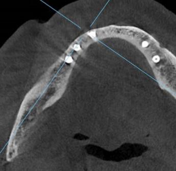CBCT and Panoramic X-ray view show