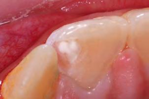 Dentin tubule