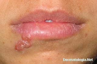 Oral-facial Herpes Acute Gingivostomatitis Acute gingivostomatitis is the commonest manifestation of primary herpetic infection. The patient experiences pain and bleeding of the gums.
