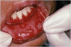 Herpes labialis (cold sore, fever blisters) Following primary infection, 45% of orally infected individuals will experience reactivation.