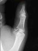 GAMEKEEPER S (SKIER S) THUMB Ulnar collateral ligament (UCL) of thumb MCP joint UCL critical for pinch and grasp Forced radial abduction MCP joint Assoc avulsion fracture is common Treatment Partial