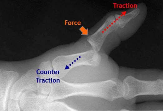 TRACTION WITHOUT DORSAL FORCE = VOLAR PLATE ENTRAPPED M-C Neck M-C Shaft M-C Head Thumb Dislocation PARONYCHIA Acute nailbed infection usually staph Chronic infection: C.