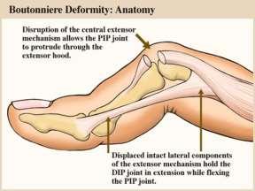 BOUTONNIERE DEFORMITY Central slip disruption at PIP Forced flexion at PIP against resistance Results in DIP extension PIP flexion Splint in extension Amputation Mallet Finger Boutonniere Splinting