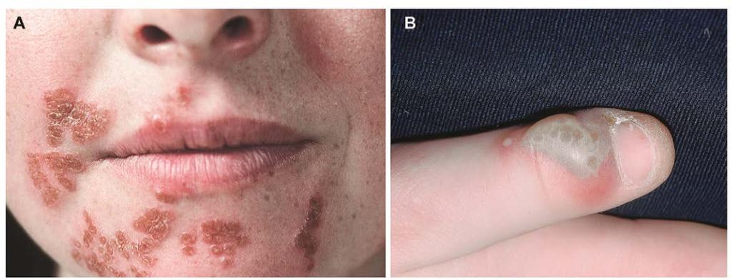 drug, acyclovir, was developed to treat herpes simplex (A) Lesions of recurrent labial HSV, in the healing