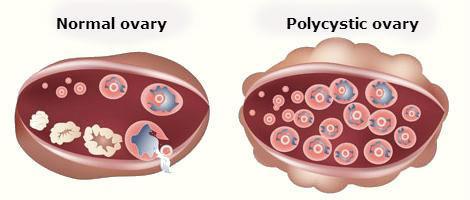 Polycystic Ovaries Are they really cysts?