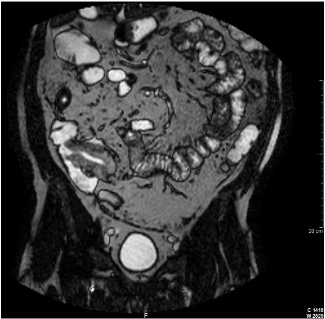 154 J.E. Baars et al. least 30 35 cm (Fig. 1). Furthermore, there was infiltration of the surrounding fat tissues with enlarged mesenterial glands without metastasis.