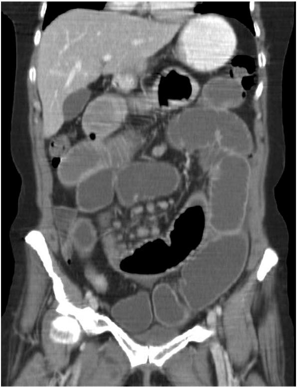 Small bowel carcinoma in Crohn's disease 155 Figure 3 An abdominal CT-scan of patient 3 showing a stenosis in the terminal ileum with prestenotic dilatation of the entire small intestine.