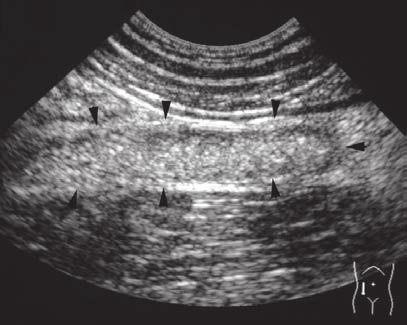 Figure 4 (left): Transverse ultrasound image of an ileo-ileal intussusception (arrow heads) in the left flank of a 3-year old child.