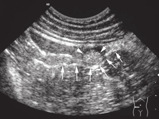 This was assumed to be an appendicolith. The A-P view showed a normal bowel gas pattern, with a mild scoliosis concave to the right.
