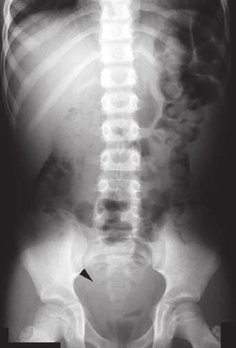 radiographs (Figure 6c). The infected nature of the collection is apparent from the reactive oedema of the adjacent posterior bladder wall (Figure 6d).