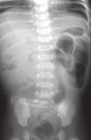 (Figure 7b). This is indicative of a midgut malrotation. Further scanning revealed the ultrasonic whirlpool sign, pathognomonic of a volvulus.