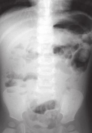 Figure 7a (far right): Supine abdominal radiograph showing some dilated bowel loops in the left upper quadrant.