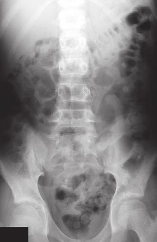 Figure 9b: Transverse image of a loop of ileum, which has a thickened wall (outlined by arrow heads) due to Crohn s disease.