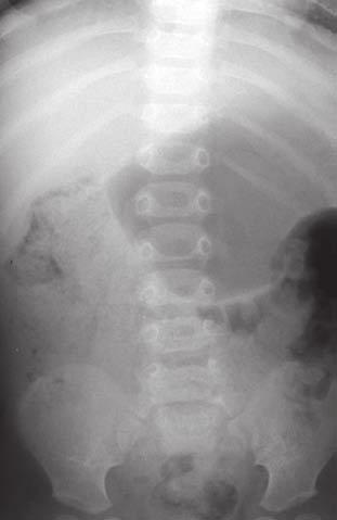Case 10 A one-year-old boy presented with episodes of grunting and screaming, possibly due to intussusception. There was a normal gas pattern throughout small and large bowel on the plain radiograph.