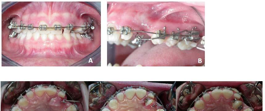 Use of Cantilever Mechanics for Impacted Teeth: Case Series The Open Dentistry Journal, 2013, Volume 7 195 Fig. (14). CASE 3 Cantilever in place (A-B).
