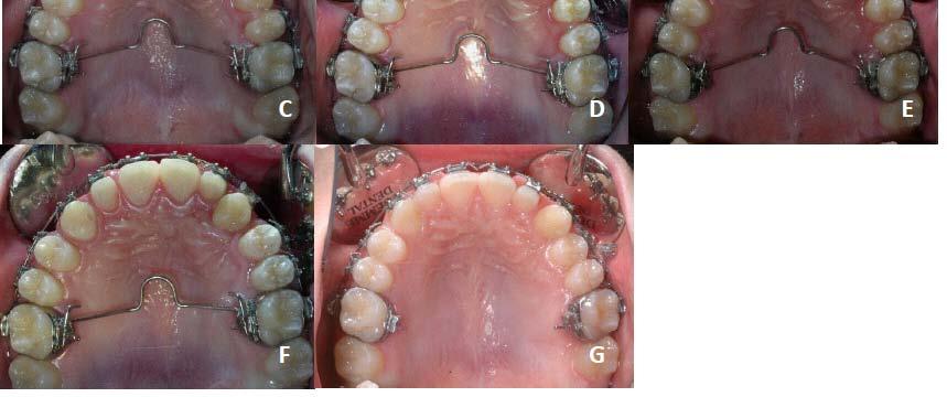 Angle Class I malocclusion class III tendency; Retruded profile Presence of the left deciduous maxillary canine, and impaction of the permanent maxillary canine.