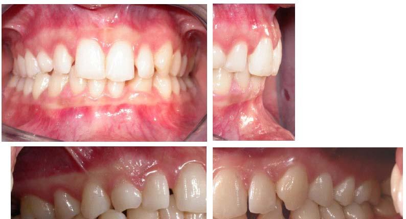 Extra oral photographs before treatment.