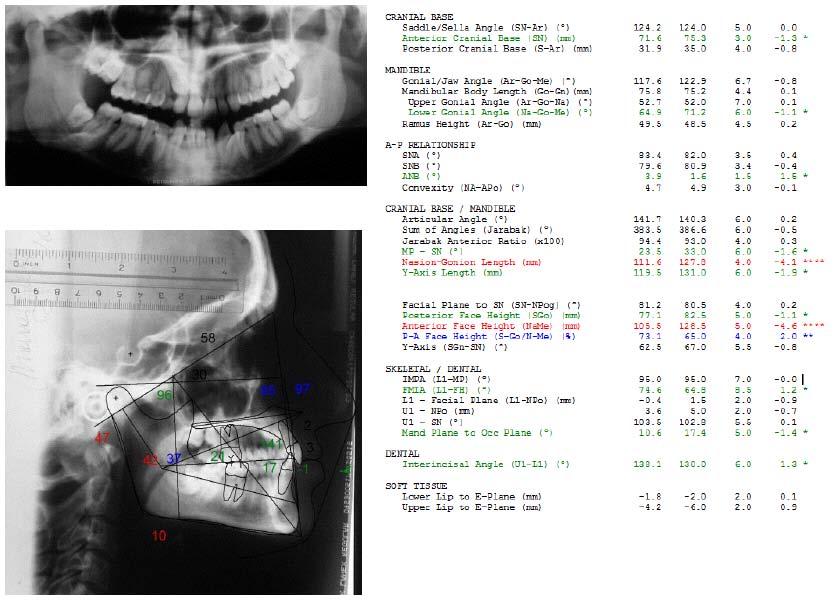 188 The Open Dentistry Journal, 2013, Volume 7 Paduano et al. Fig. (3). Cephalometric values and panoramic radiograph at the start of treatment.