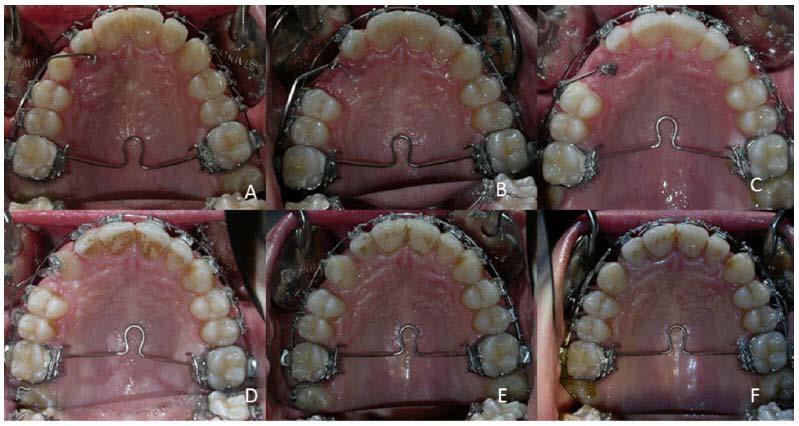 Use of Cantilever Mechanics for Impacted Teeth: Case Series The Open Dentistry Journal, 2013, Volume 7 189 Fig. (4). Recovery of the impacted right maxillary canine. The effects of a 0.019x0.