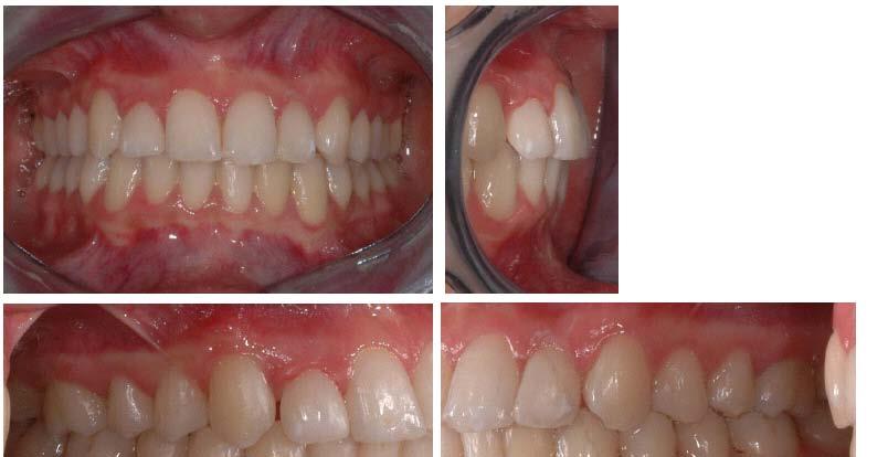 190 The Open Dentistry Journal, 2013, Volume 7 Paduano et al. Fig. (6). Intraoral photographs after treatment. Archwire Selection -.