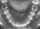 First-order bends mesial to the lower cuspid brackets are frequently required. Other problems exist with occlusal interferences and hygiene.
