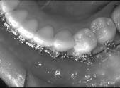 In deep-bite cases, the thicker brackets caused occlusal interferences with the upper incisors, sometimes resulting in debonded brackets and other times in notched incisal edges of the upper incisors.