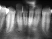 Tooth-specific Orthos lower anterior brackets with progressive distal root tip. Figure 19.