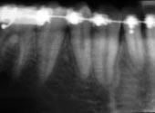 0 on lower 1st molar tubes (Figure 22).