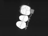 Solution 6: Correct distal root tip is incorporated into upper 2nd bicuspid brackets.