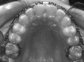 Figure 31. Maxillary arch showing central groove alignment using Orthos. Figure 32. Maxillary posterior segments can compromise cuspid rise occlusion as a result of balancing interferences. Figure 33.
