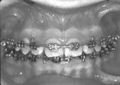 Dr. Scott continued from preceding page Case in Progress Appointment #3, week 12. Bonded upper 5 to 5 with Orthos brackets.