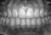 tooth movement indicates that reduced friction allows