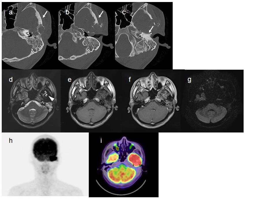 PET/CT of Temporal Bone Chondroblastoma Toriihara A et al symptoms.