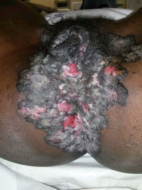 Vulval Squamous Carcinoma 1) Warty/basaloid type: younger