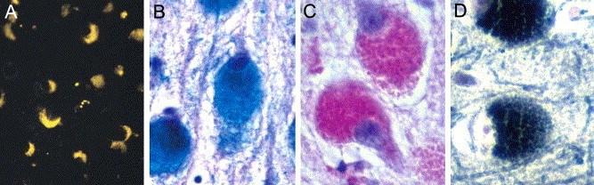 Neuronal Ceroid Lipofuscin (A) Autofluorescent intraneuronal storage material (CLN5) (B)