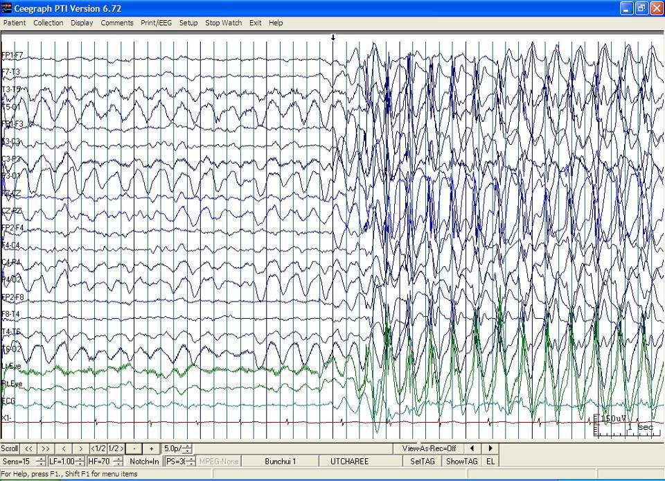 Generalized 3-Hz-spike-and-waves 1 SEC Juvenile absence epilepsy Age of onset 8-20 years ( peak 9-13 years) Seizure type EEG Absence (not frequent, not severe, awareness) GTC at onset-> Absence in