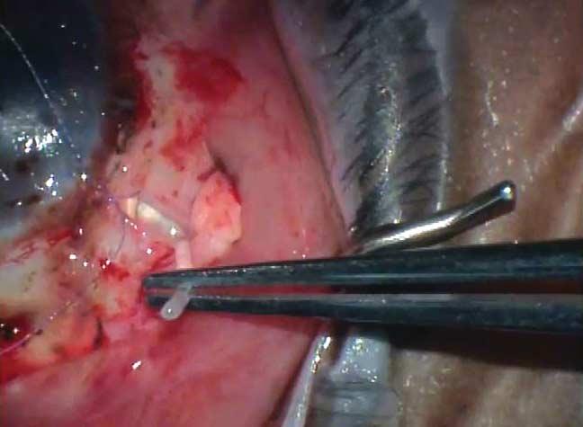 The plug is then trimmed until flush with the scleral surface.