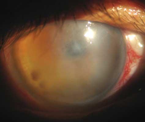 Moster RA, Hill RA. Intermediate-term clinical experience with the Ahmed Glaucoma Valve implant. Am J Ophthalmol. 1999;127(1):27-33. 6. Siegner SW, Netland PA, Urban RC Jr, et al.