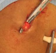 when attempting to retract catheter cuff