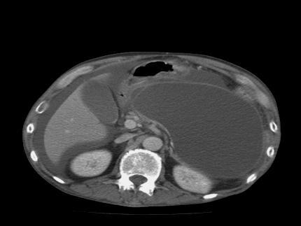 EUS Guided pseudocyst drainage 20 to 40 % of patients with CP develops this complication