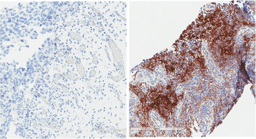 Conversion of PD-L1(-) to PD-L1() in Tumor Biopsies