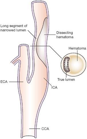 Pathophysiology Usually arises from an intimal tear Intramural hematoma forms, compressing lumen Subintimal dissection